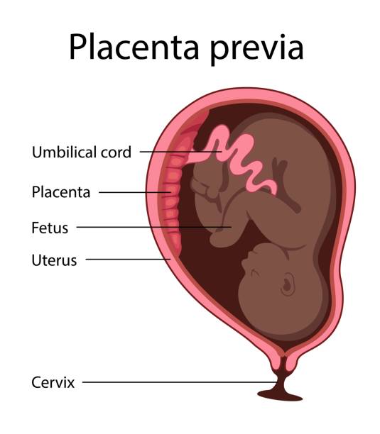 Placenta Previa 